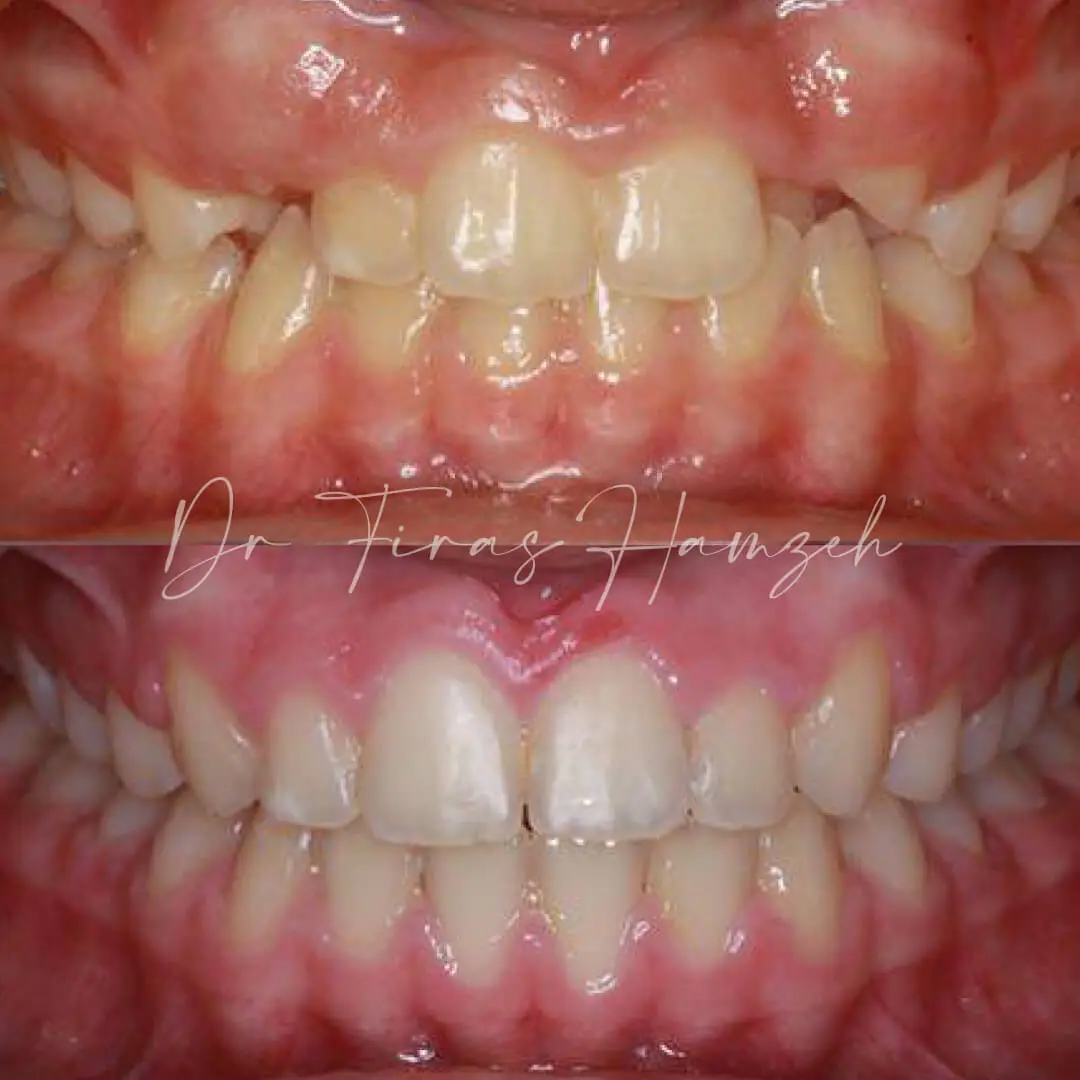Before and after orthodontic case 10