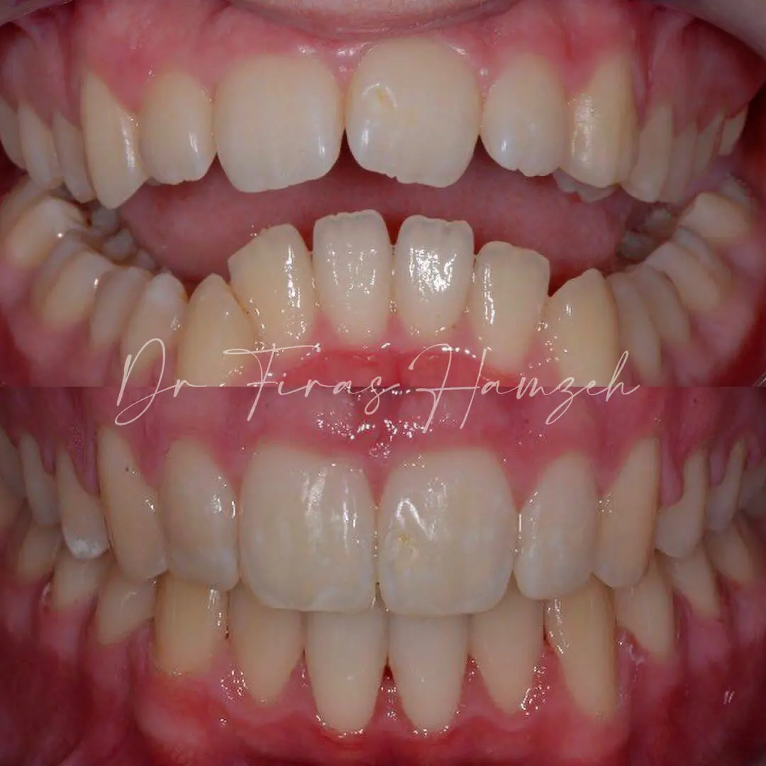 Before and after orthodontic case 11