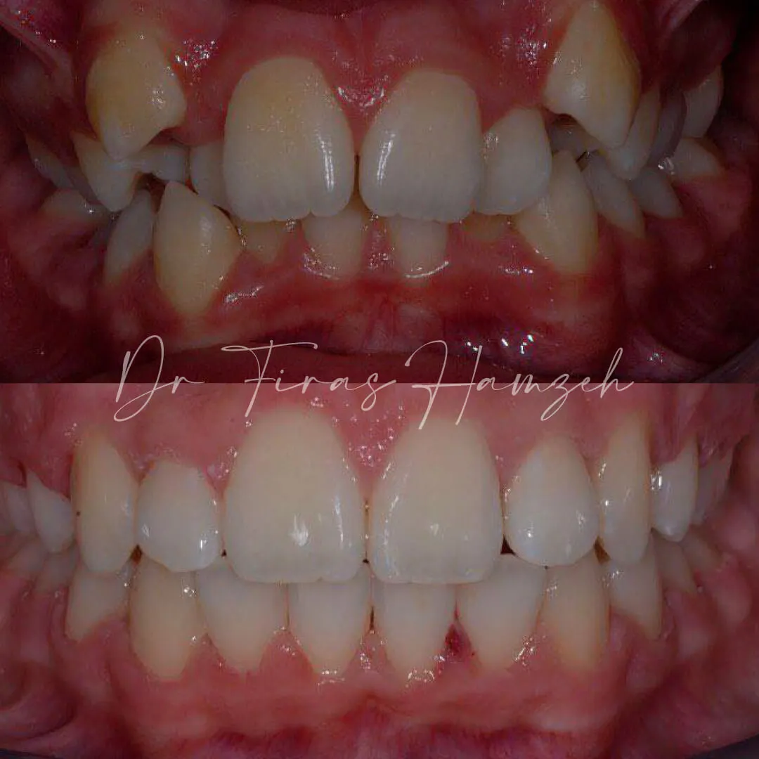 Before and after orthodontic case 12