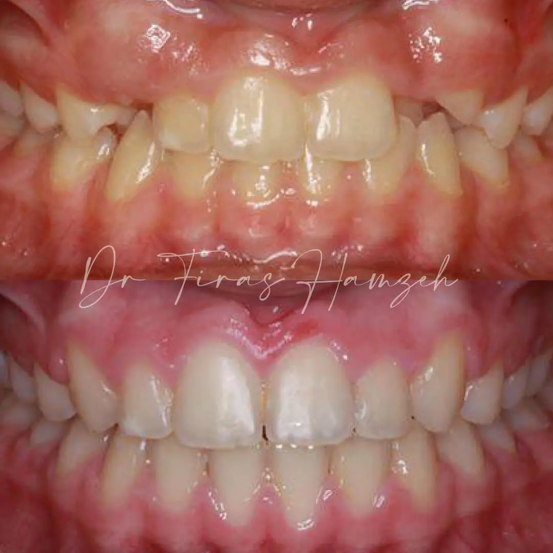 Before and after orthodontic case 2