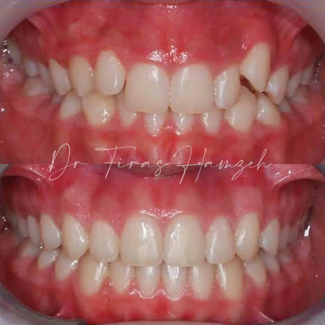 Before and after orthodontic case 3