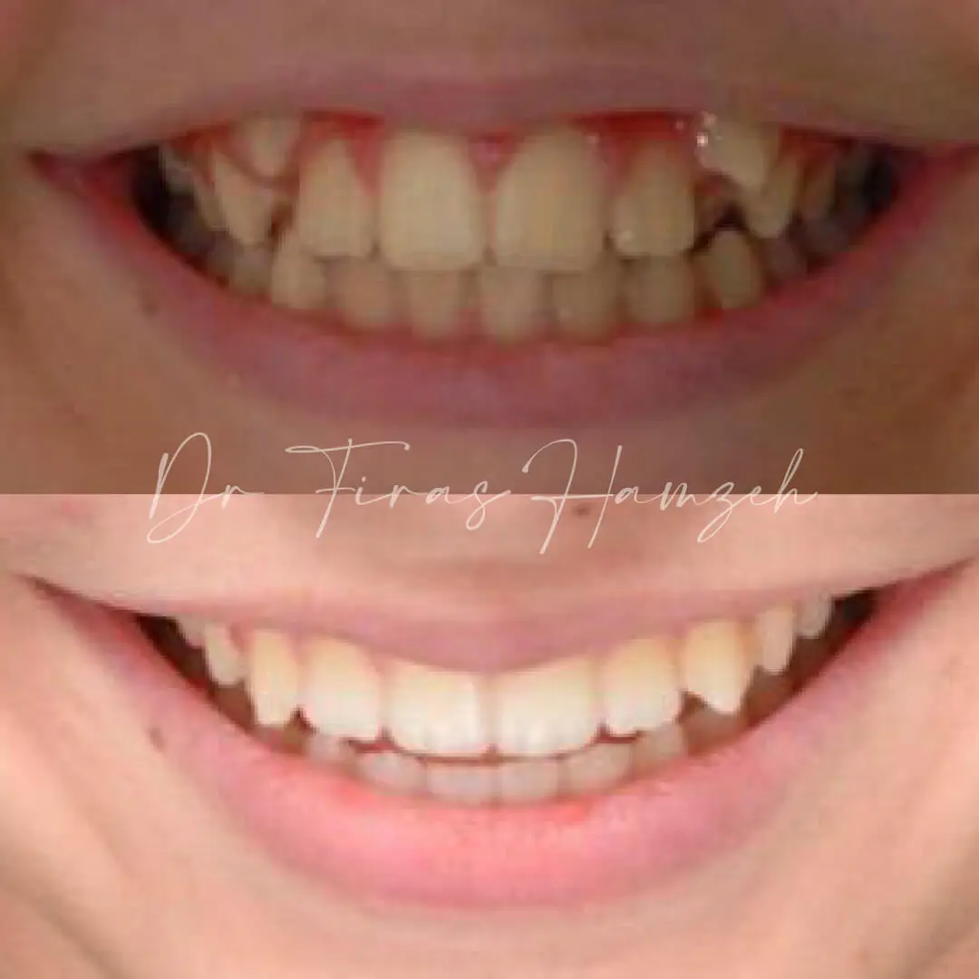 Before and after orthodontic case 7