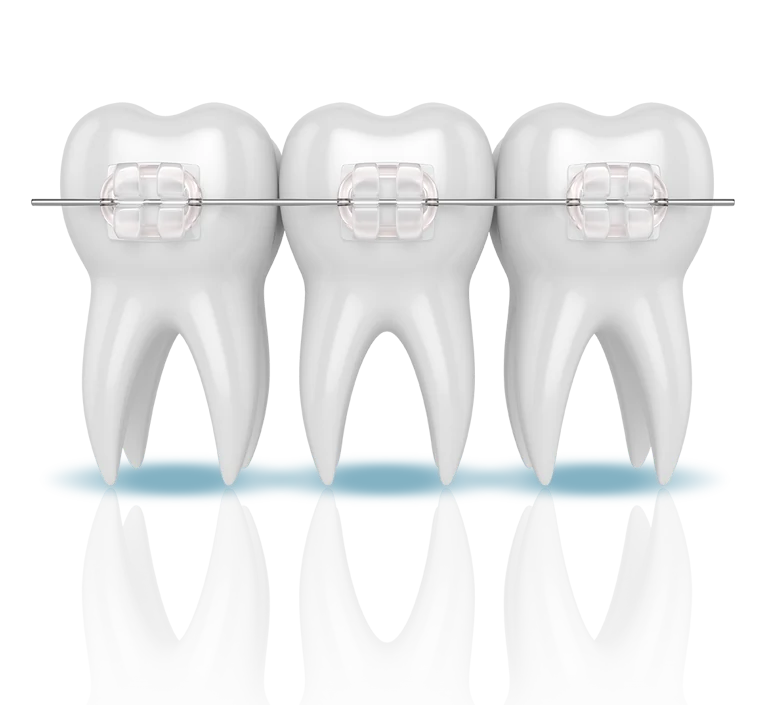 Damon self-ligating braces on teeth with archwire
