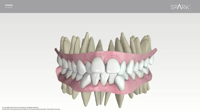 3D simulation of tooth and root movement