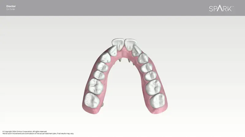 3D simulation of bite and occlusion planning